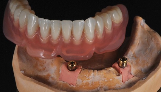 hybridni-nahrada-zubni-laborator-jslab